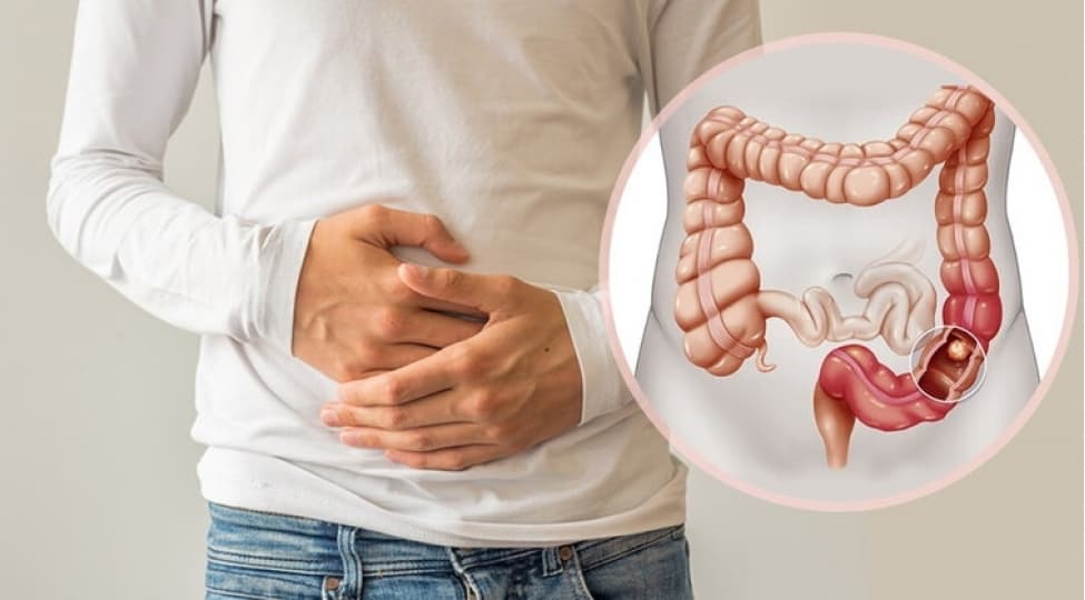 Mart yoğun bağırsaq xərçəngi ilə mübarizə ayıdır