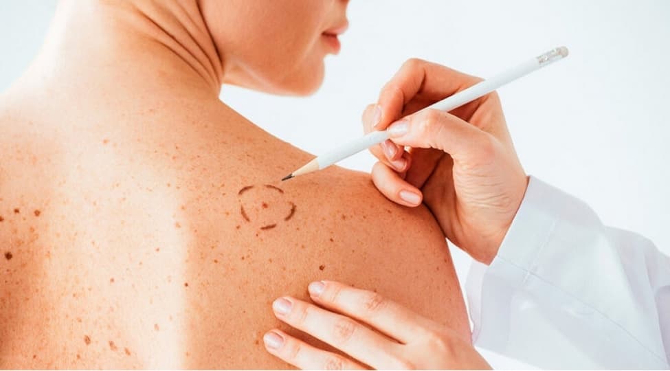 Xal yoxsa dəri xərçəngi?